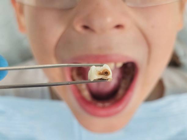 Best Emergency Broken Tooth Repair in Long Creek, IL